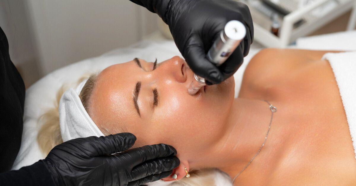 Microneedling